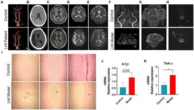 Microbiome-gut-brain axis contributes to patients and Bama miniature pigs with acute large ischemic stroke